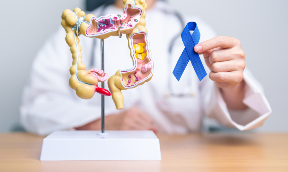 How Your Lifestyle Invites Colon Cancer