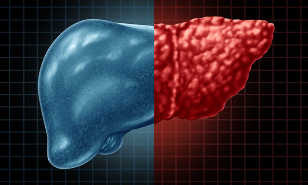 Fatty Liver, How It Affects Your Gut Health