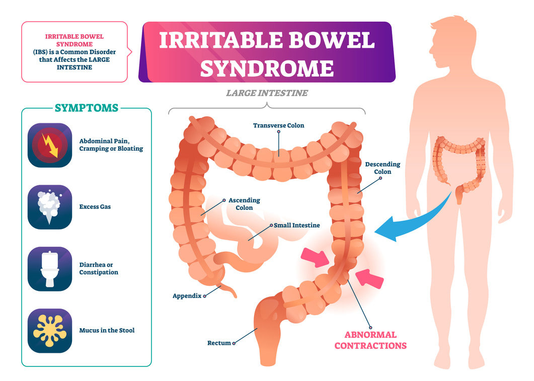 Ansiedad y sindrome de intestino irritable